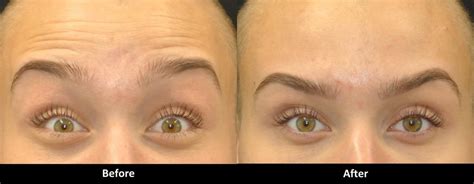 <b>Botox</b> injections typically start working one to three days after therapy. . How long does heavy brow last after botox